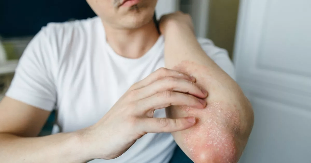 25 حالة جلدية تؤهلك للحصول على 400 جنيه إسترليني شهريًا من برنامج عمل الدوحة.